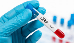 CRP Nedir? CRP Yüksekliği Ne Anlama Gelir? Nasıl Düşürülür?