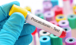 Prokalsitonin (PCT) Nedir? PCT Kaç Olmalıdır? PCT Yüksekliğinin Nedenleri