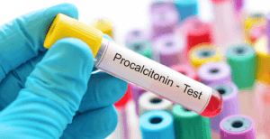 Prokalsitonin (PCT) Nedir? PCT Kaç Olmalıdır? PCT Yüksekliğinin Nedenleri