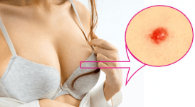 Vücutta Kırmızı Lekeler Neden Çıkar? Kırmızı Lekeler Hangi Hastalığın Belirtisi?