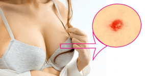 Vücutta Kırmızı Lekeler Neden Çıkar? Kırmızı Lekeler Hangi Hastalığın Belirtisi?