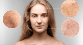 Cilt Lekeleri Nasıl Geçer? Cilt Lekeleri için Evde Çözüm Önerileri