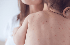 Kızıl Hastalığı Nedir? Belirtileri ve Tedavisi Nasıldır?
