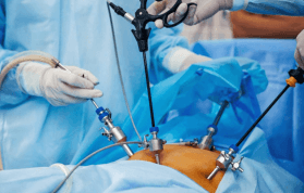 Mide Küçültme (Tüp Mide) Ameliyatı Hakkında A'dan Z'ye Tüm Detaylar