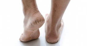 Topuk Çatlağı Neden Oluşur? Topuk Çatlağına Ne İyi Gelir?