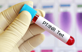 Protrombin Zamanı (PT) Testi, Yüksekliği, Düşüklüğü Nedir?