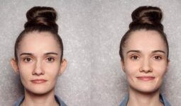 Kepçe Kulak Ameliyatı (Otoplasti) Nedir?