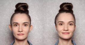 Kepçe Kulak Ameliyatı (Otoplasti) Nedir?