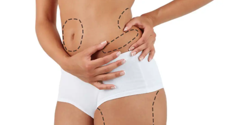 Yağ Aldırma Ameliyatı Nedir?